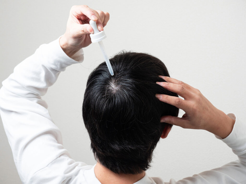 Prescription topical treatments for hair loss